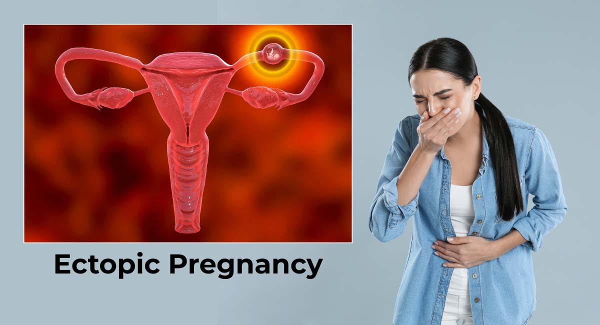 Ectopic Pregnancy
