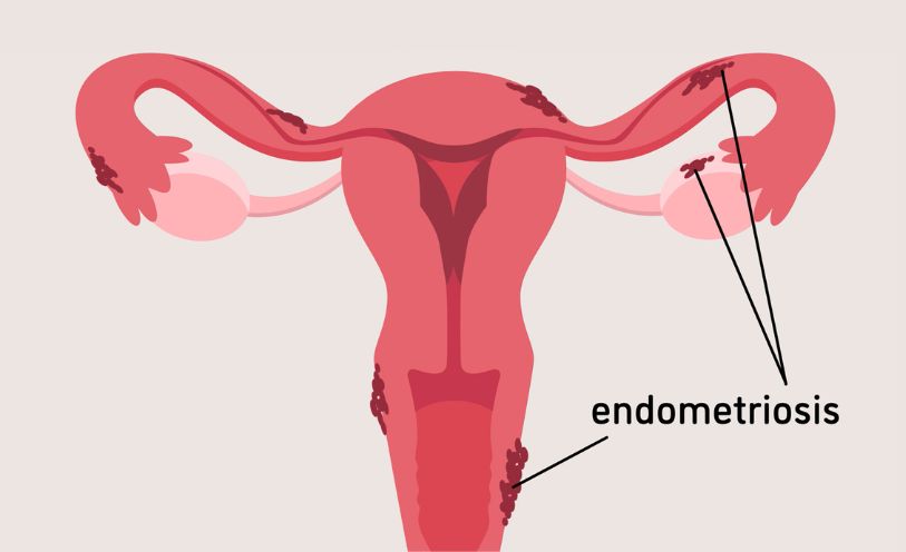 Hysteroscopic Septum Resection