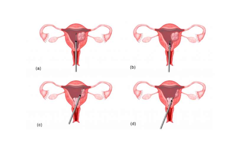 Hysteroscopic Septum Resection Surgery