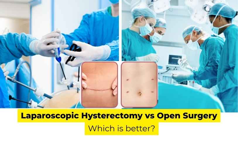 Laparoscopic Hysterectomy vs Open Surgery