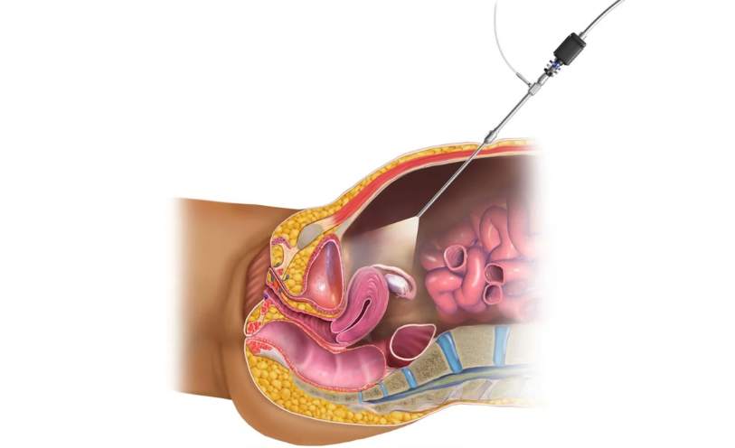 Understanding Laparoscopy for Infertility