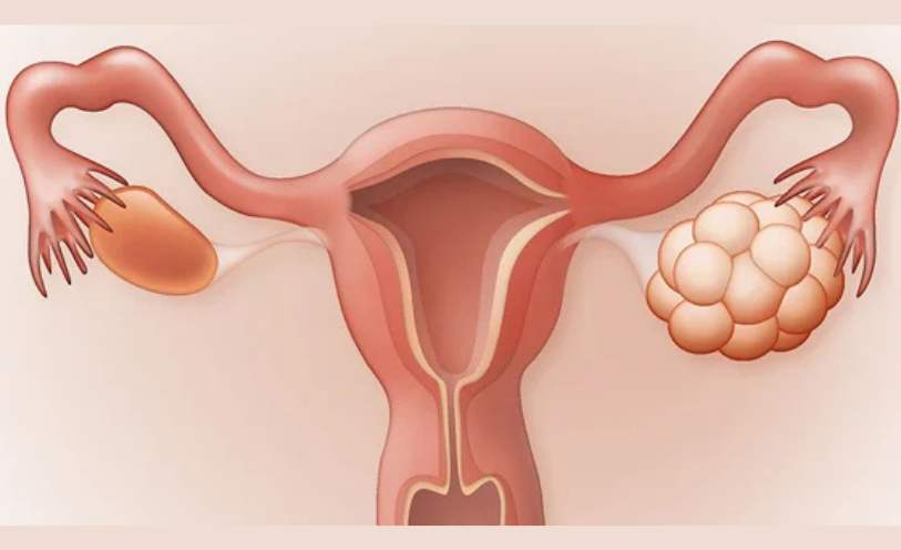 PCOD/PCOS Treatment in Gurgaon