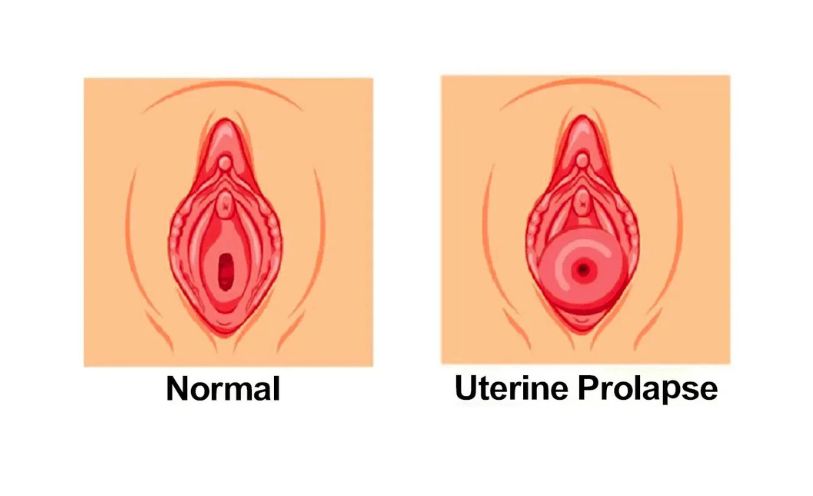 Hysteroscopic Septum Resection